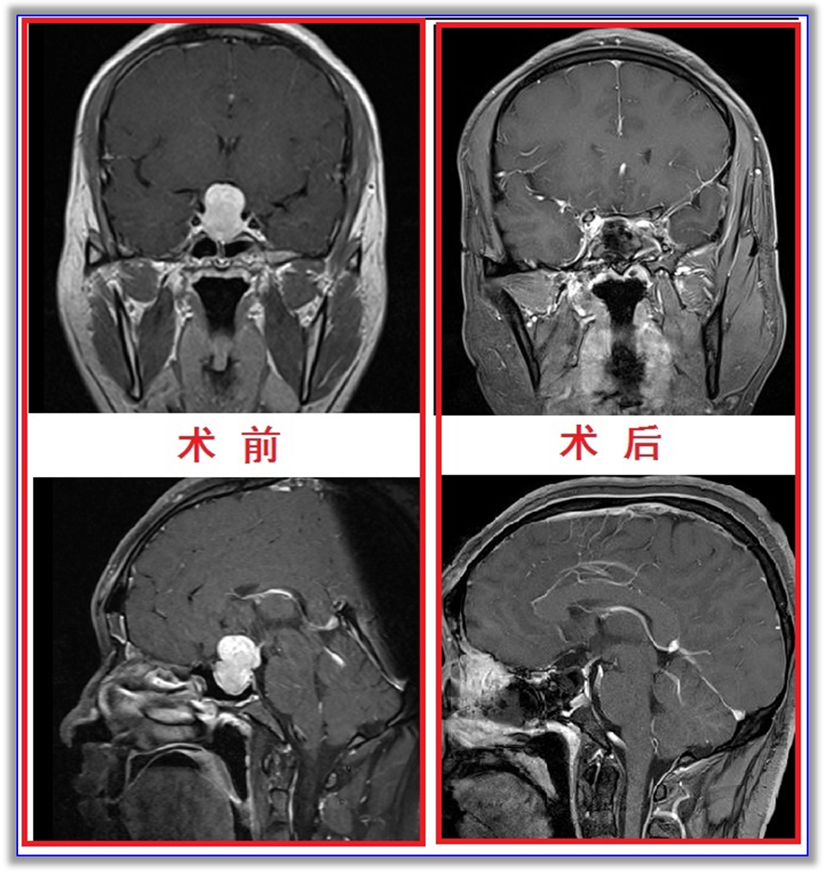 术后磁共振增强复查示肿瘤全切.png